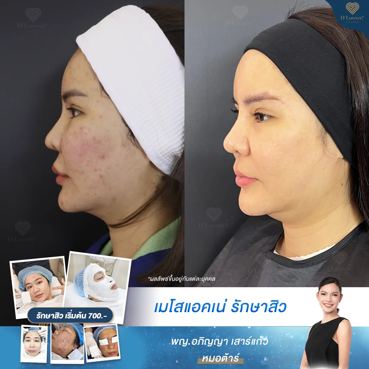 Jawline acne treatment before and after: reduced acne, smoother skin