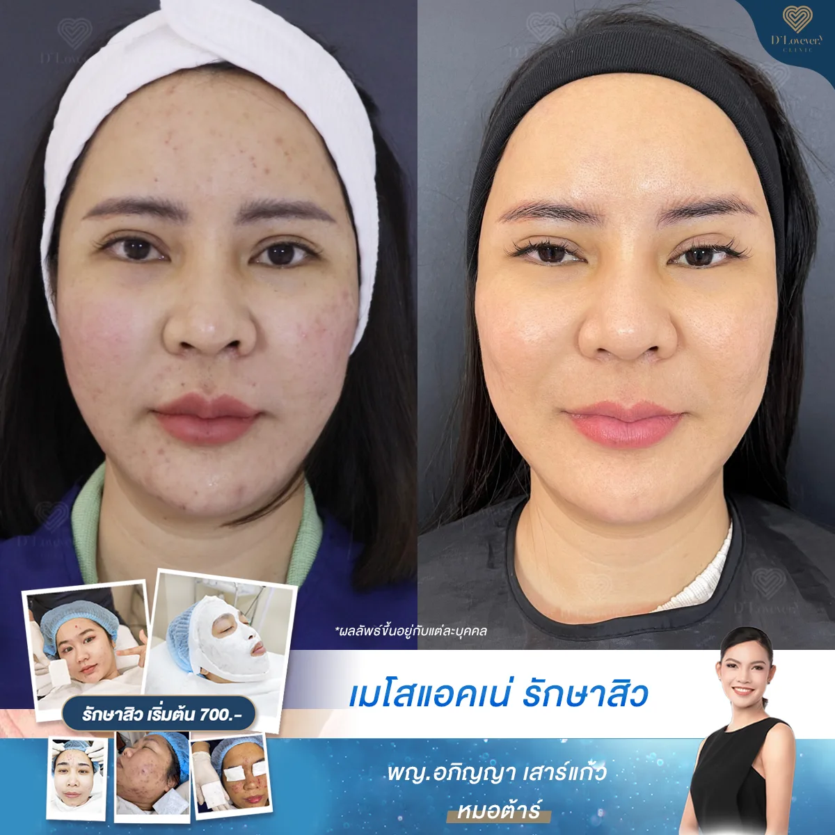 Before-and-after acne treatment: woman with reduced redness and clearer, smoother skin