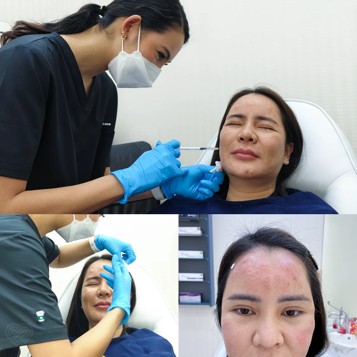 Week 1 acne facial injections in clinic showing puncture marks and localized redness