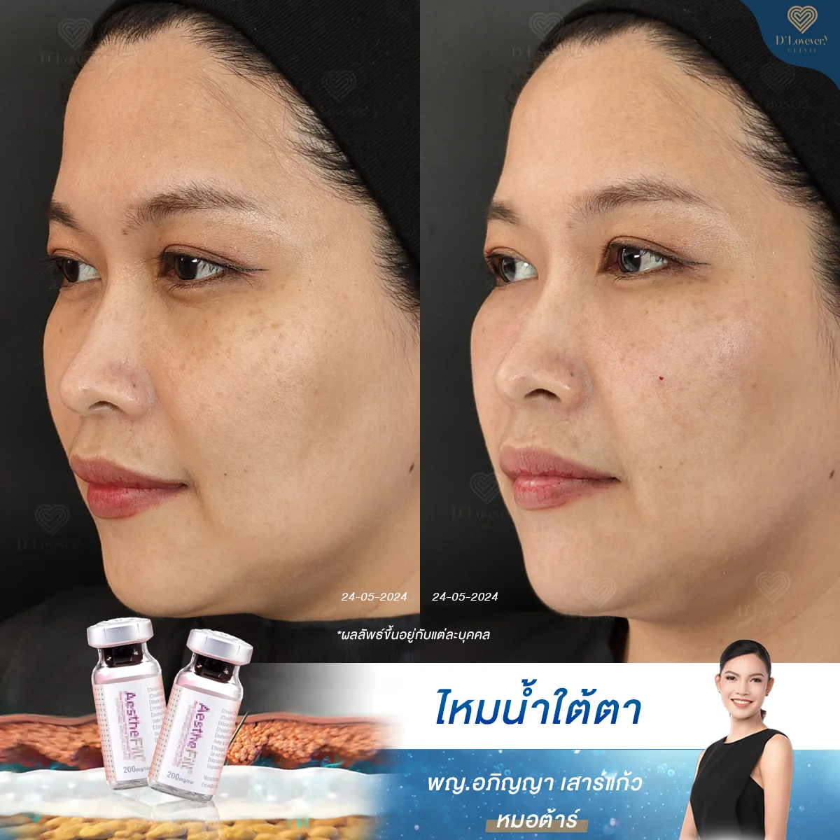 Aesthefill Before After 3 5