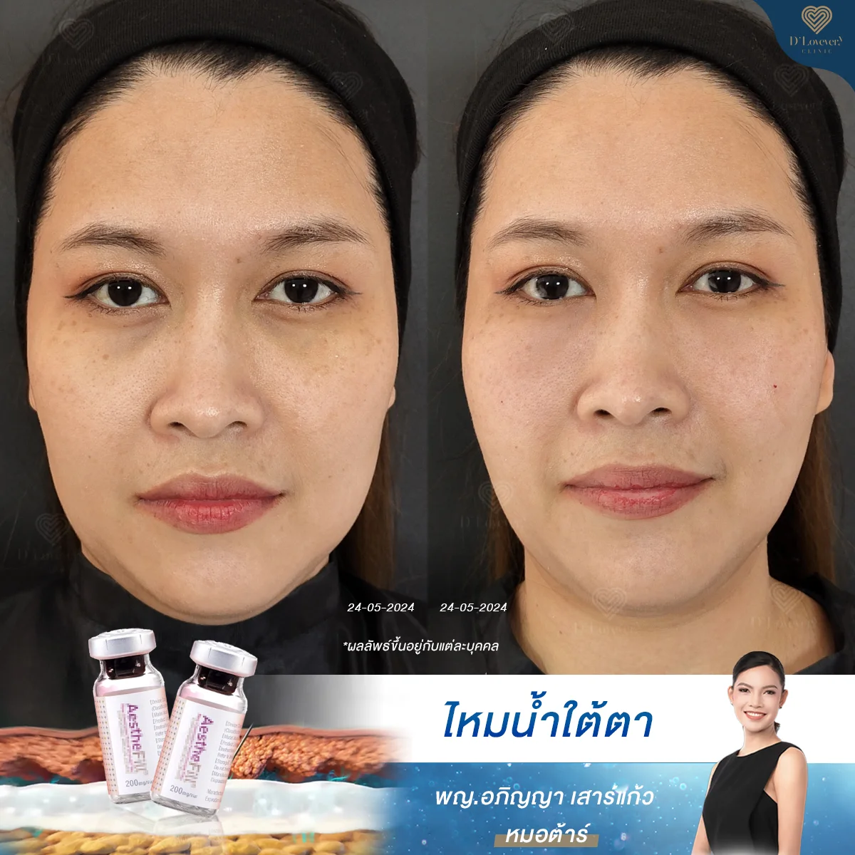 ไหมน้ำ aesthefill