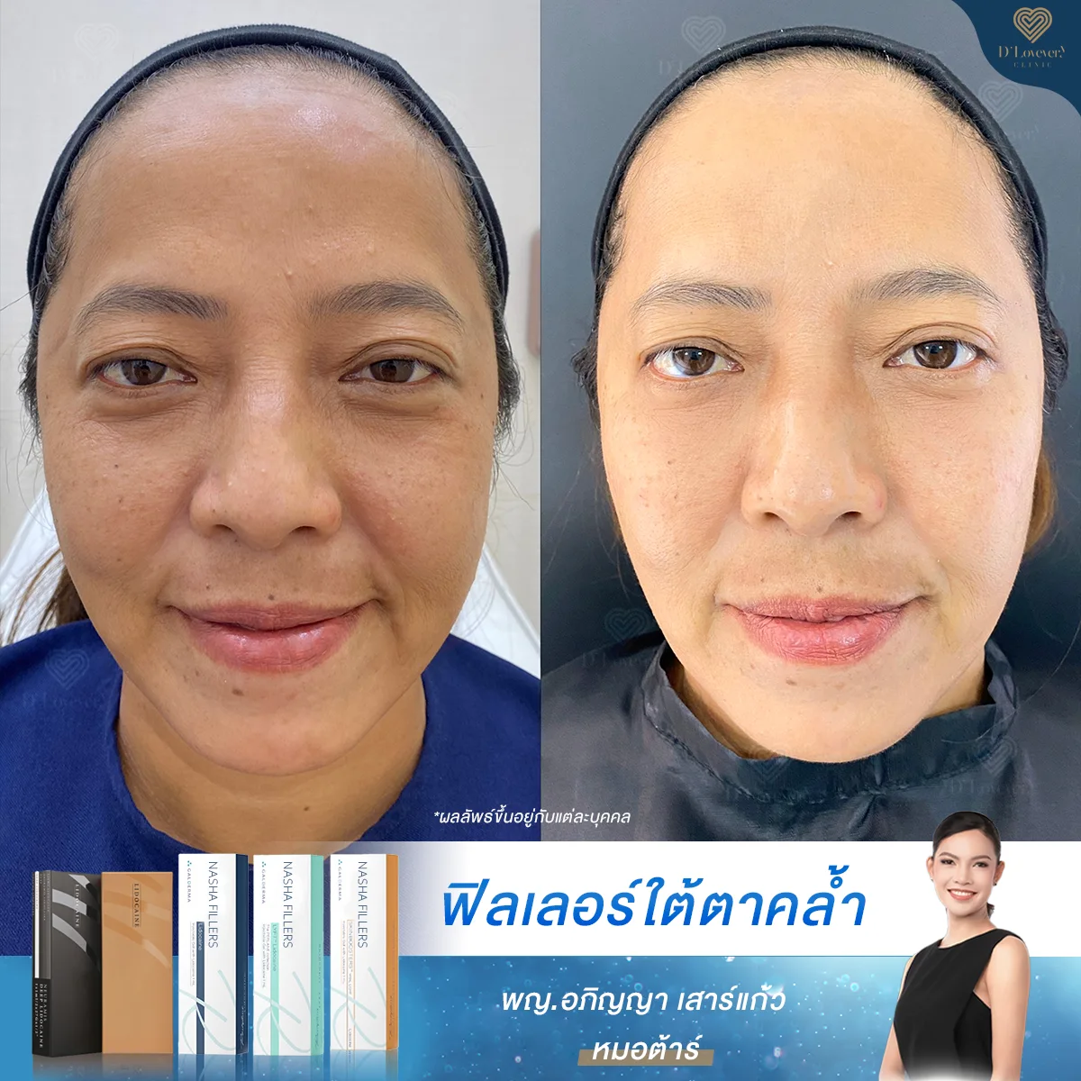 รีวิวฟิลเลอร์ใต้ตา 1 สัปดาห์