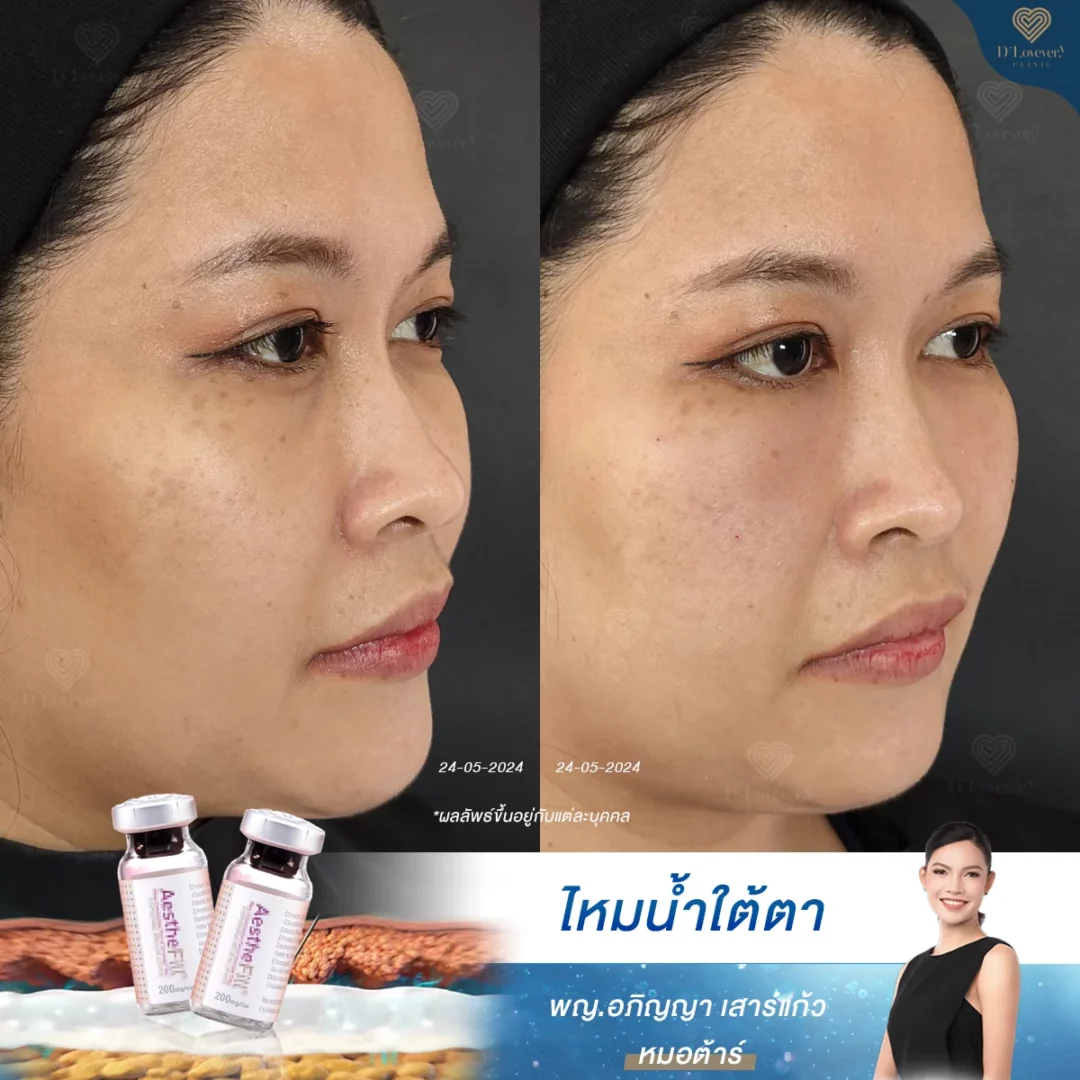 ไหมน้ำ ใต้ตา ราคา