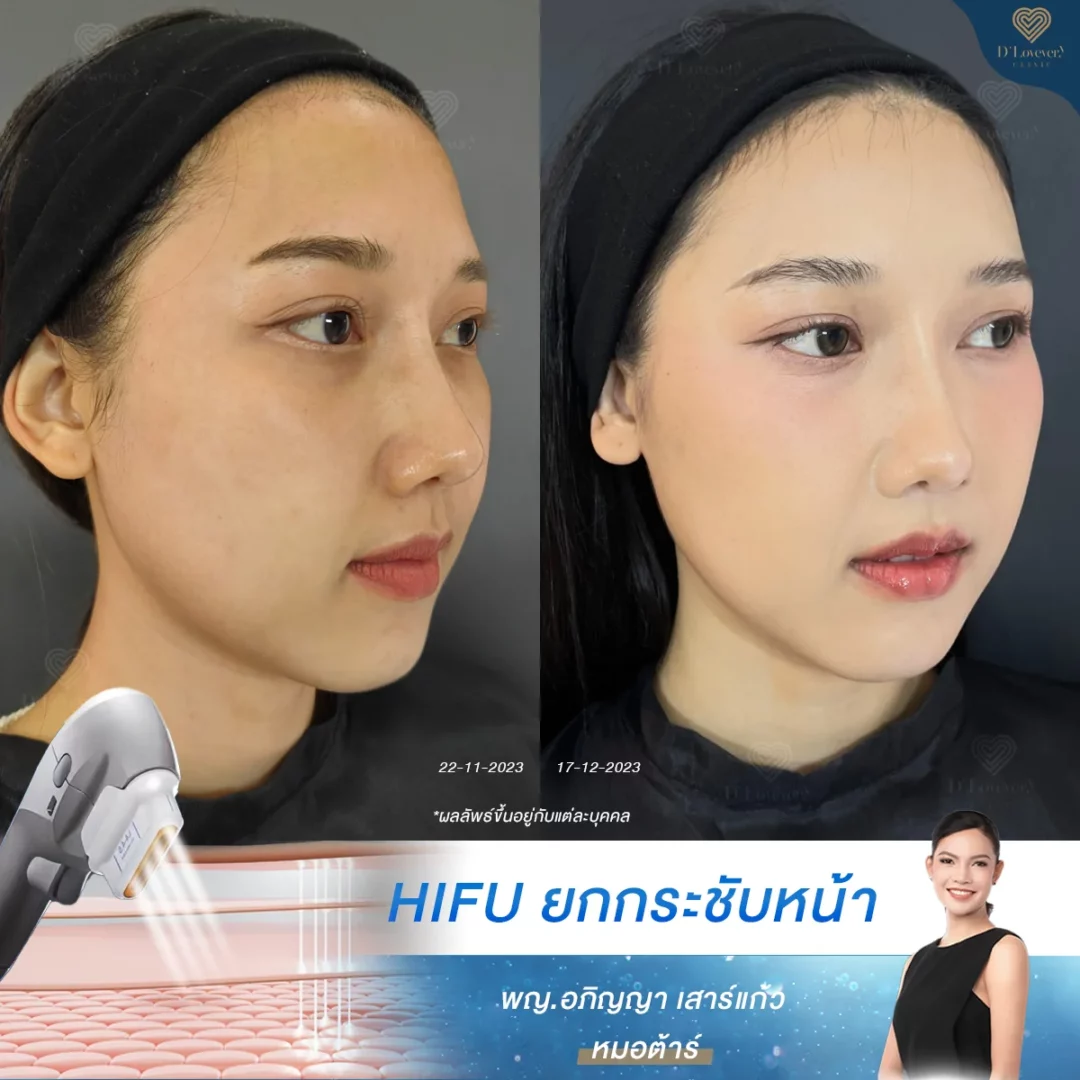 hifu ราคา