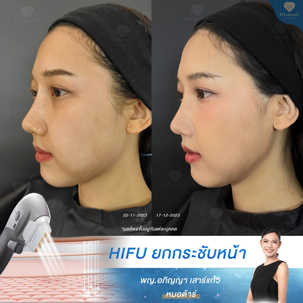 hifu ช่วยอะไร