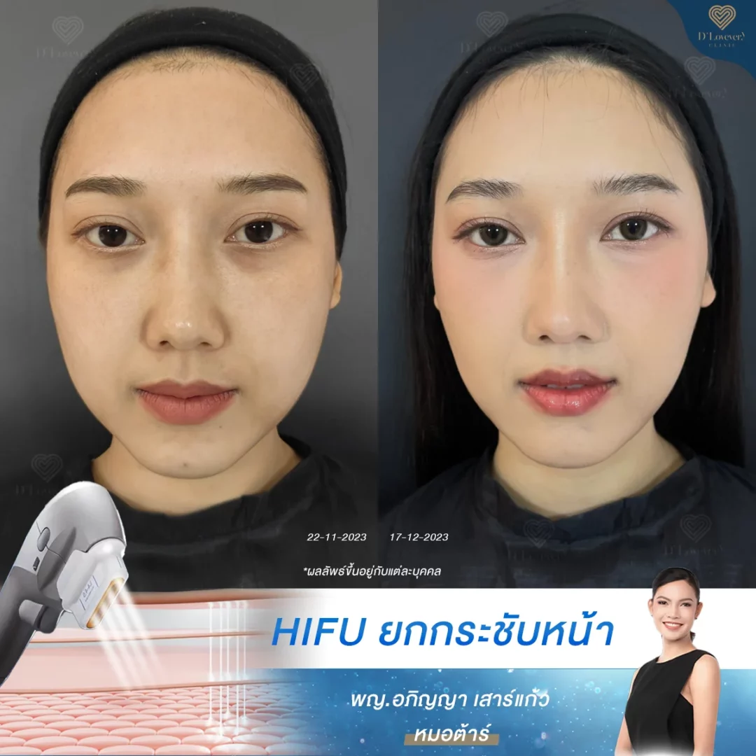 hifu อยู่ได้กี่เดือน
