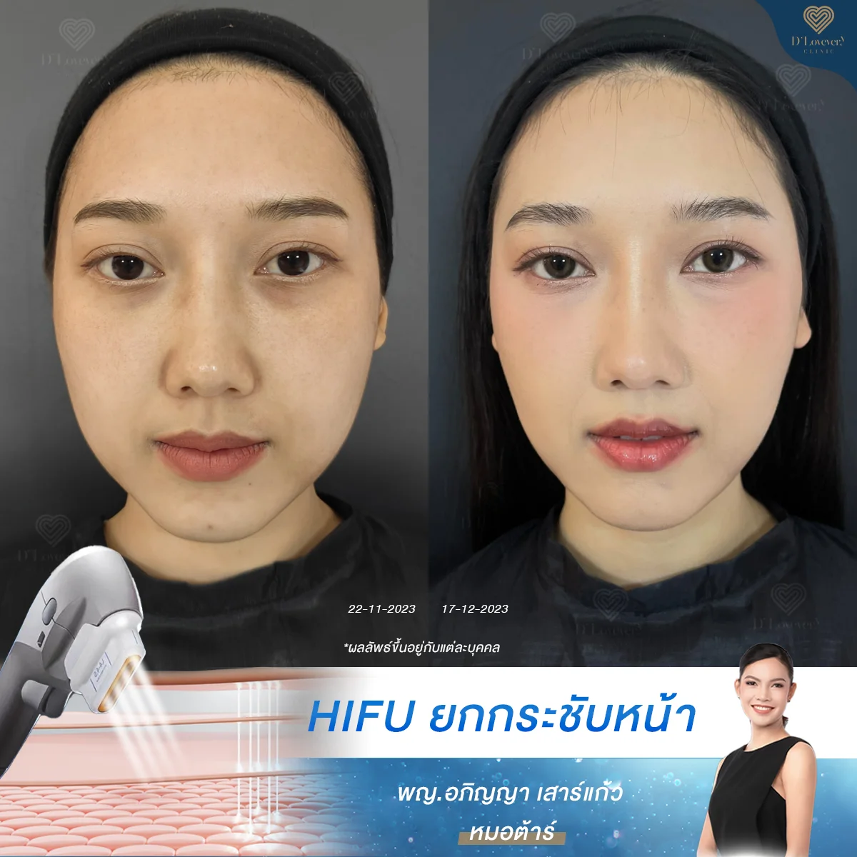 [รีวิว] แก้มเยอะ แก้มคล้อย ปล่อยไว้ไม่ได้! มาดูรีวิวยกกระชับแก้มด้วย HIFU ดูซิคุณหมอจะใช้กี่ช็อต?