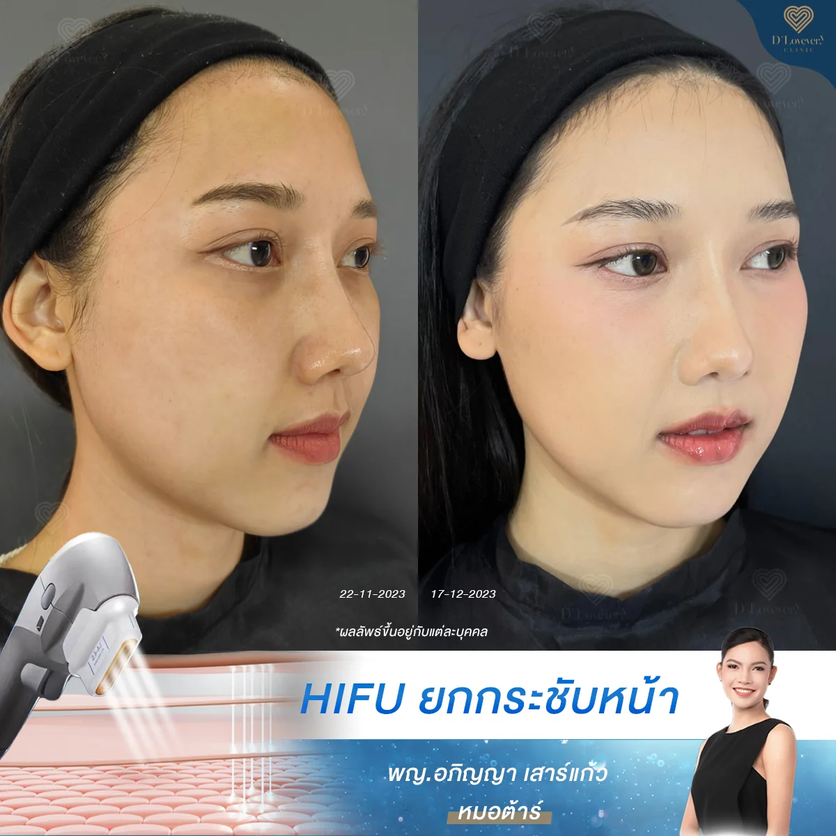 hifu ราคา