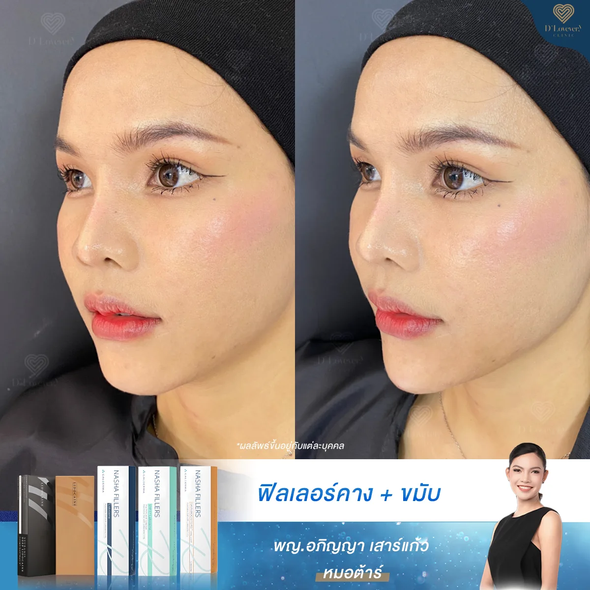 ฟิลเลอร์คาง 1cc