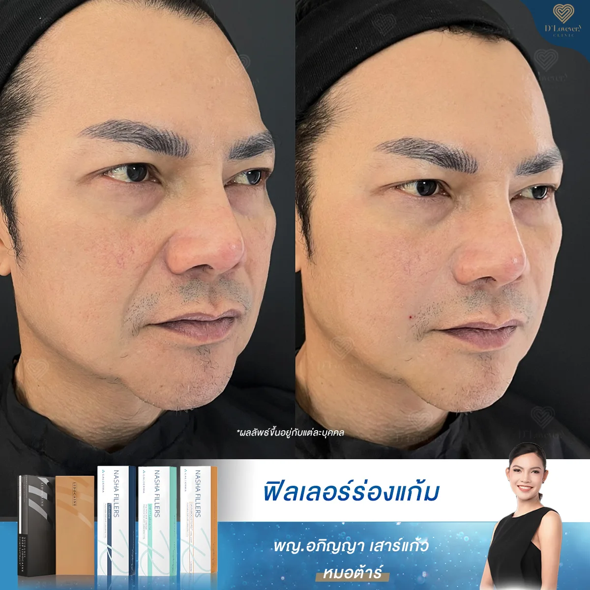 ฟิลเลอร์ร่องแก้ม ราคา