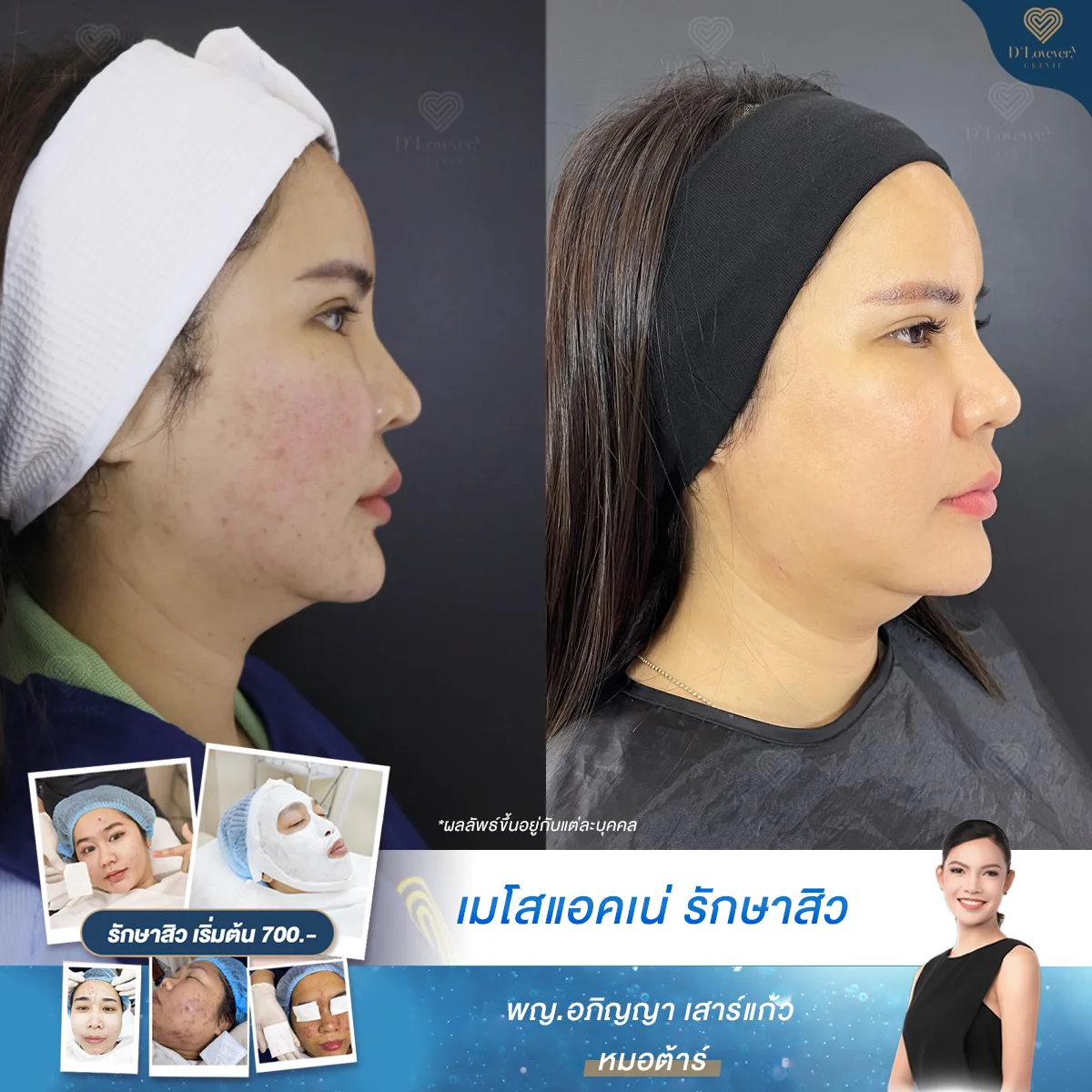 Acne treatment before-and-after: clearer skin, reduced redness, smoother jawline