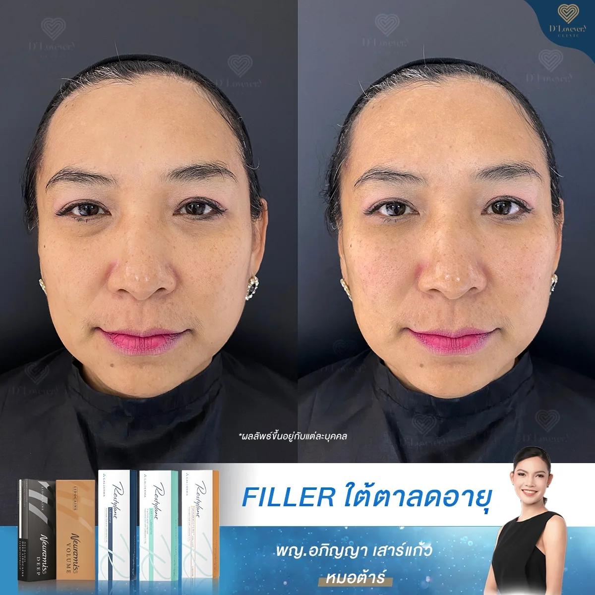 [ฉีดฟิลเลอร์ใต้ตา] ทาอายครีมแพงแค่ไหนใต้ตาก็ยังดำลึก รีวิวกู้หน้าโทรมให้กลับมาอิ่มฟู ดูเด็กขึ้นทันตา