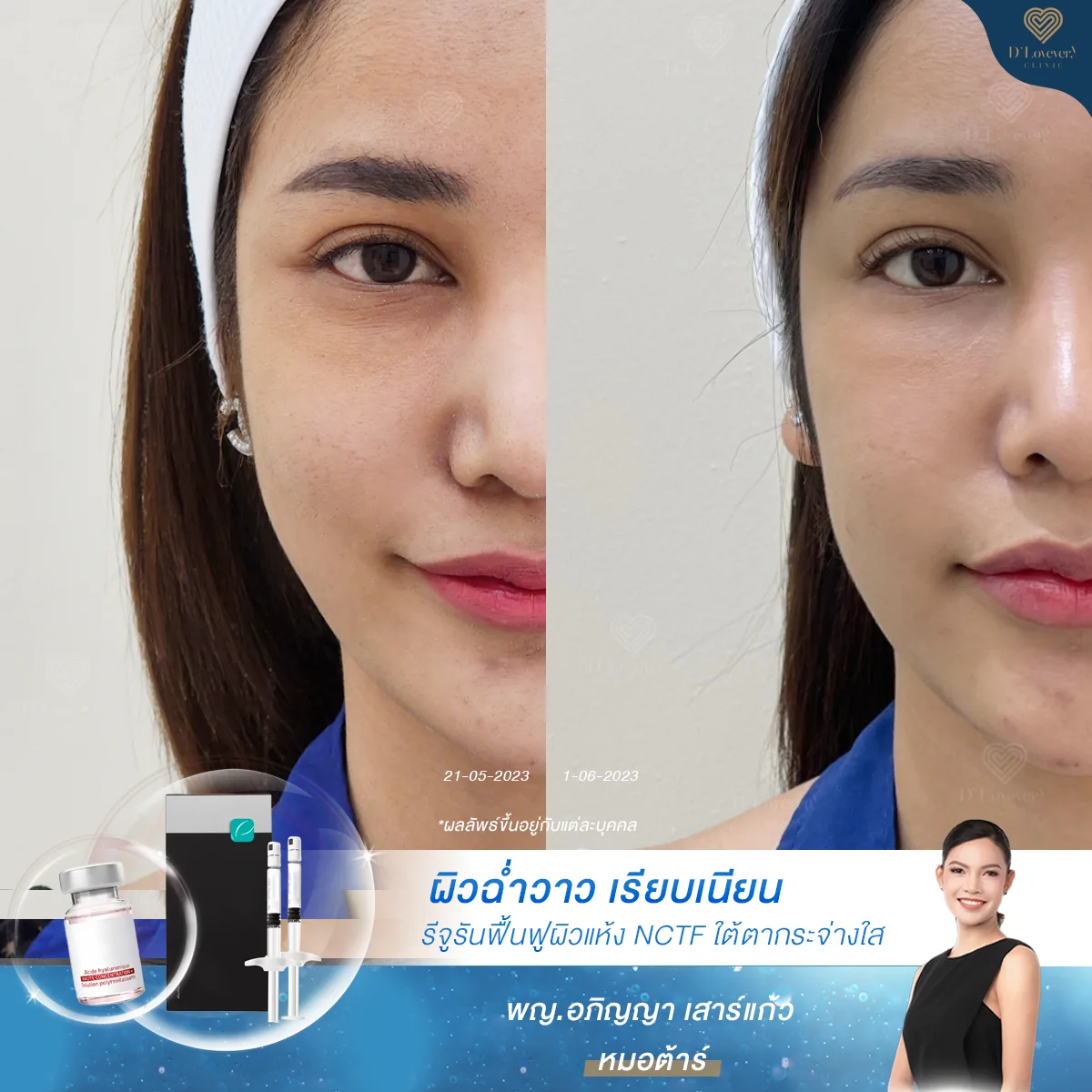 [รีวิว Glass Skin] รีวิวผิวฉ่ำ + ใต้ตากระจ่างใส รีจูรัน NCTF 135 HA ฟื้นฟูผิวที่ขาดน้ำ ผิวแห้งลอก