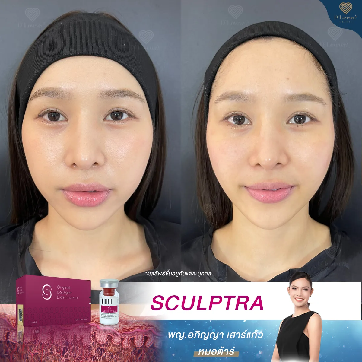 sculptra รีวิว หลังทำทันที