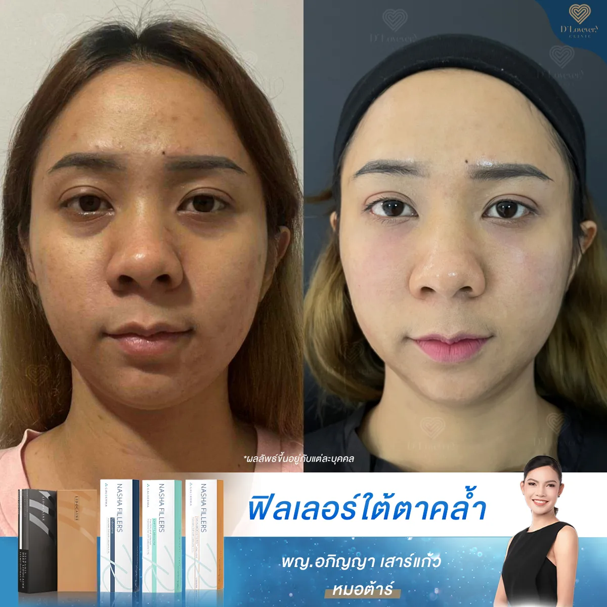 ใต้ตาคล้ำ ทำยังไง