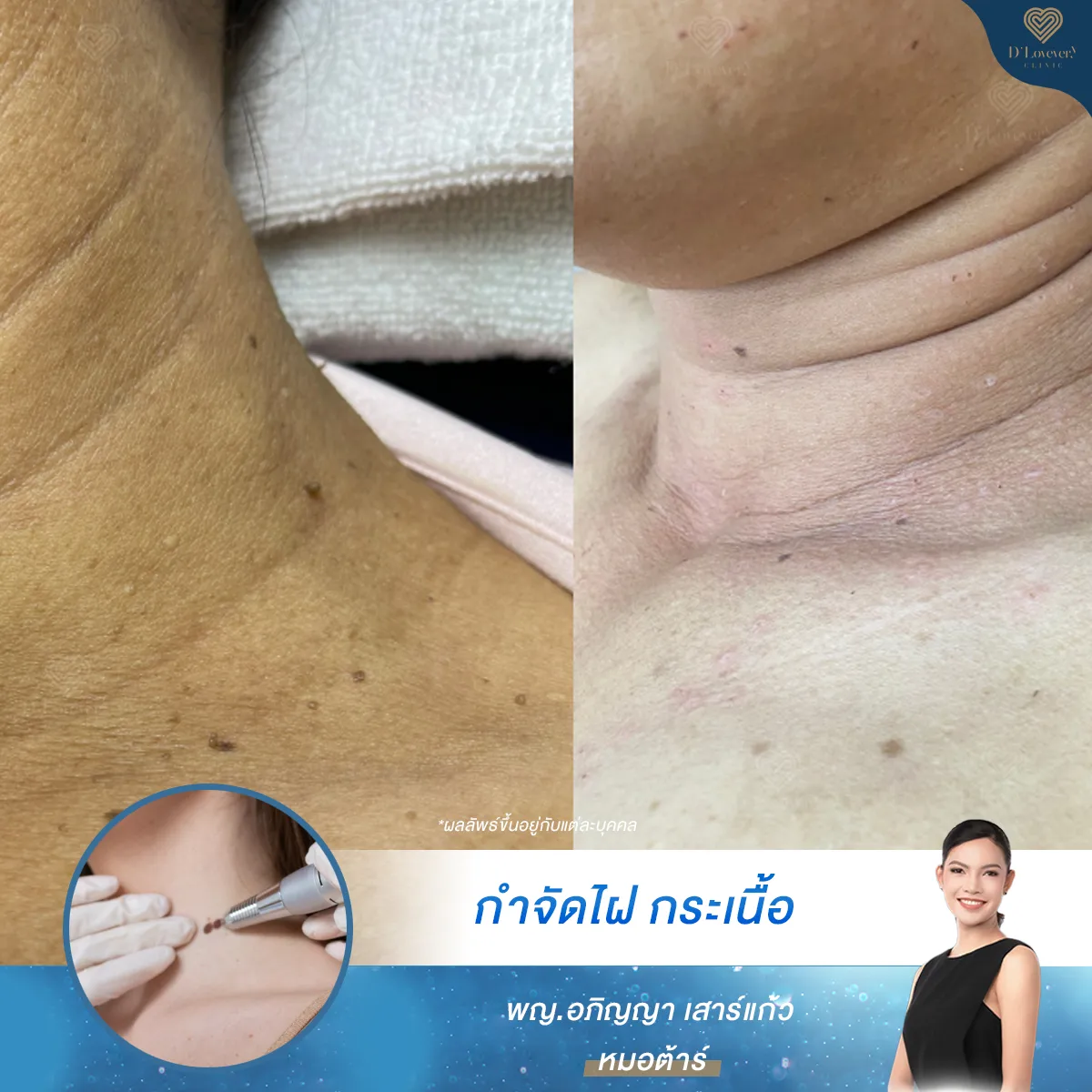 จี้กระเนื้อ ราคาเหมา