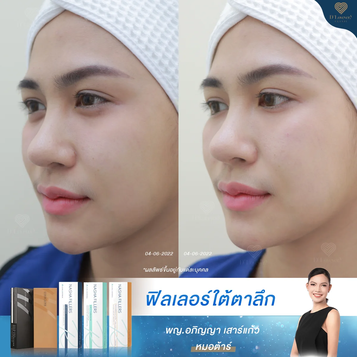 Before After Under Eyes Filler Miss Mook 2