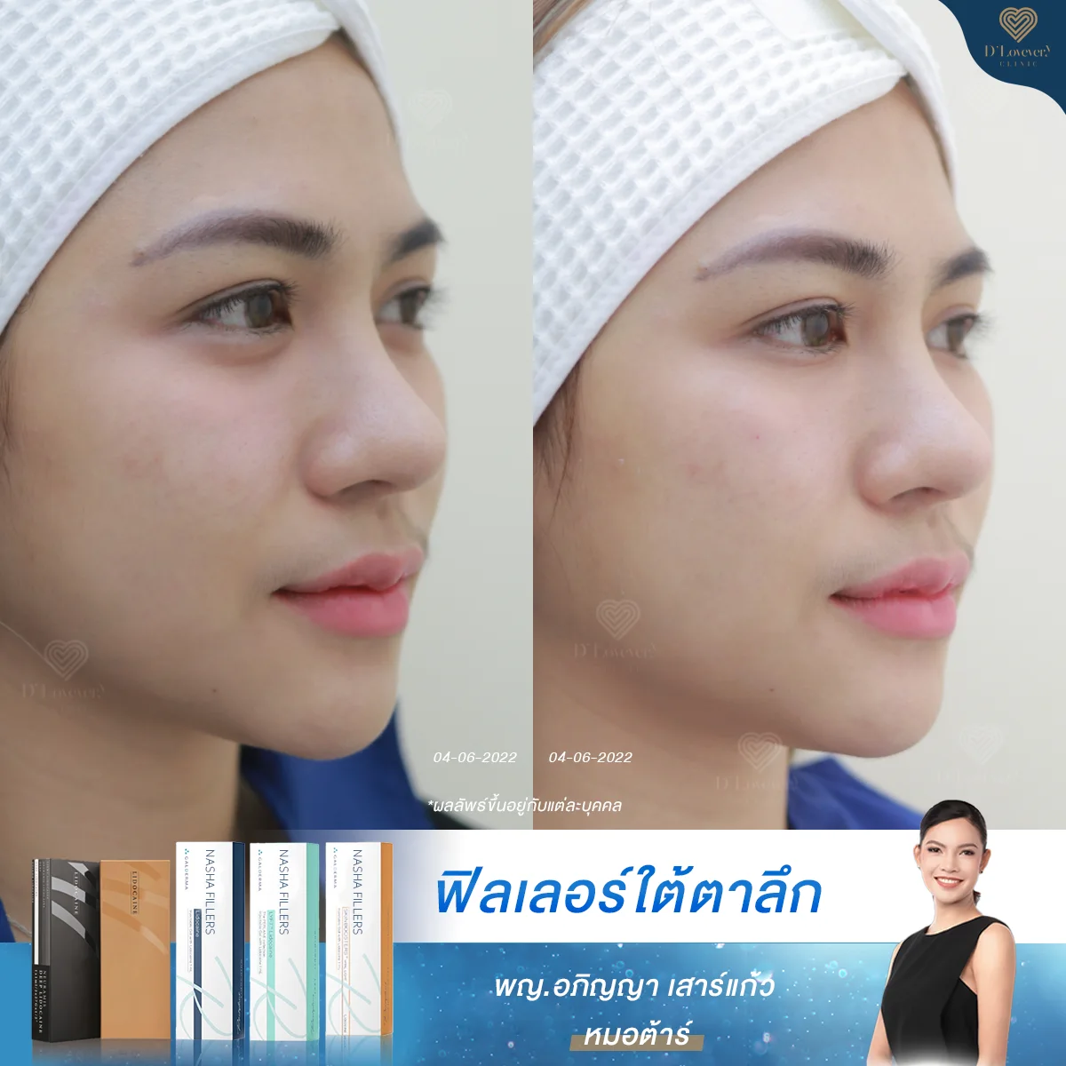 Before After Under Eyes Filler Miss Mook 3