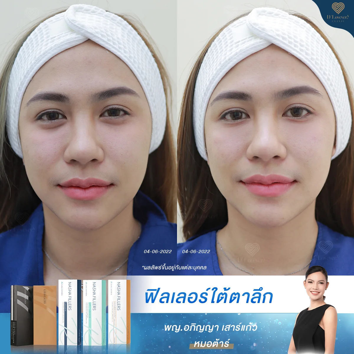 [ใต้ตาลึก] ใต้ตาเป็นแอ่ง น้องบอกจะเลี้ยงปลาทองได้อยู่แล้วนะคะหมอ! ดีเลิฟเวอรี่คลินิกจัดการได้ด้วยฟิลเลอร์