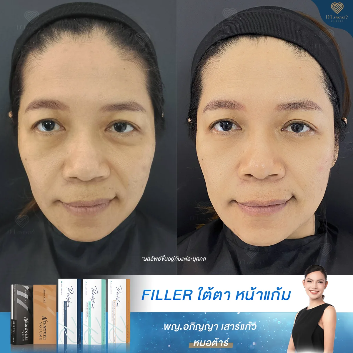 [รีวิวฉีดฟิลเลอร์ครั้งแรก] เลือกใต้ตา ร่องแก้มเลย บริเวณที่เติมแล้วเห็นความเป็นแปลงชัด ลดอายุใบหน้าลงได้ชัดเจน หมอต้าร์คอนเฟิร์ม