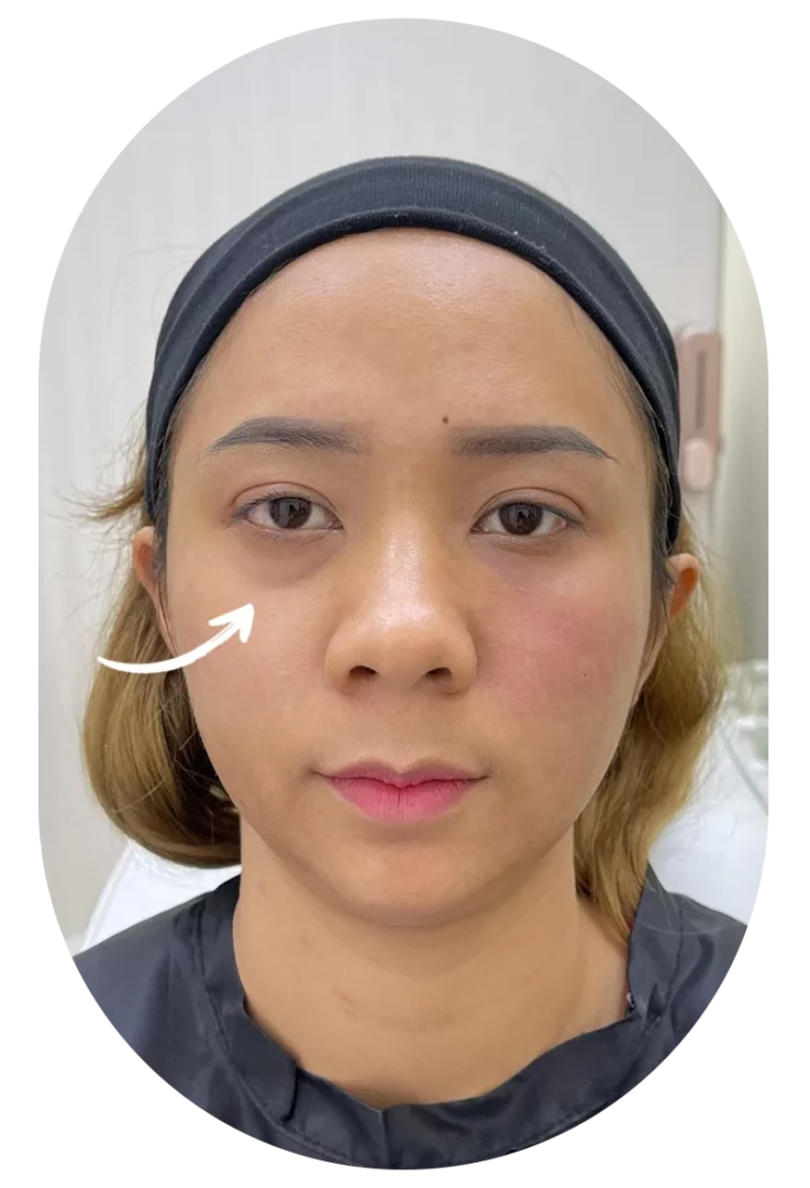 Before under-eye filler: patient with dark circles