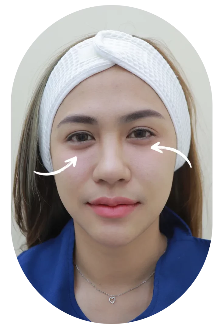 Before Under Eyes Filler Miss Mook
