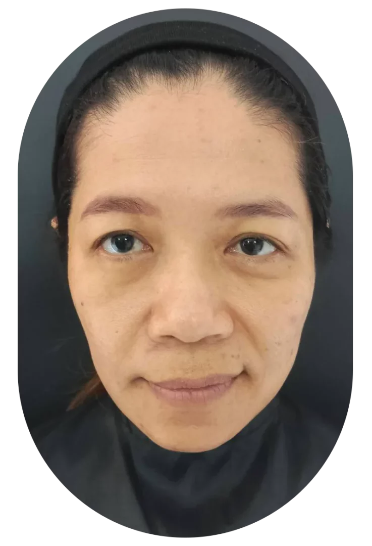 Before Under Eyes Filler Miss Poope