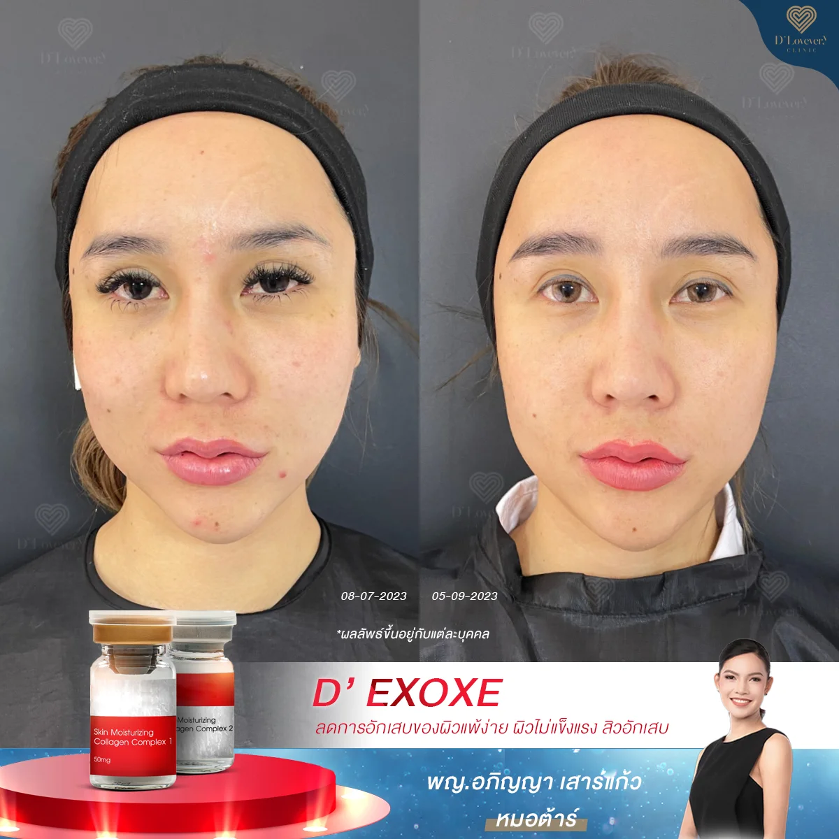 exoxe ราคา รีวิว