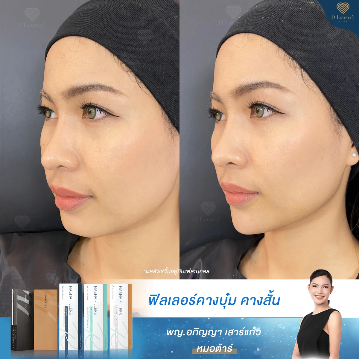 Chin Filler Make V Face Before After N Ying 2