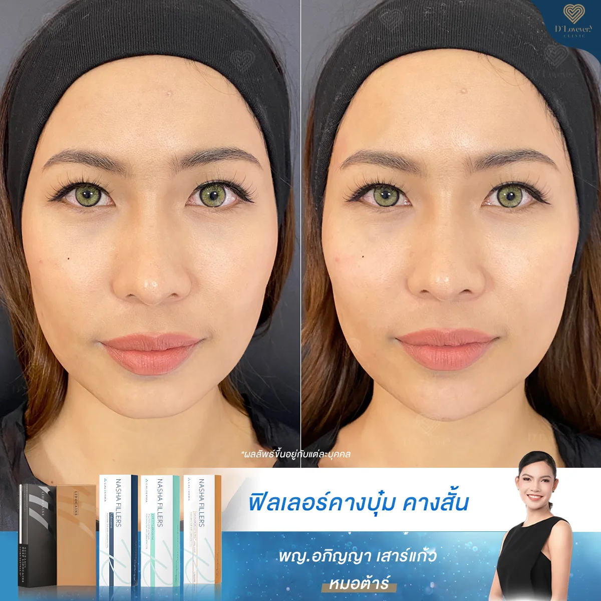 Chin Filler Make V Face Before After N Ying