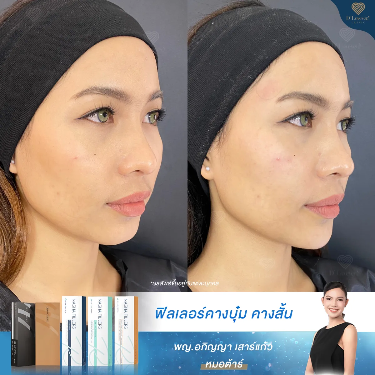 Chin V Face Filler Before After N Ying 3