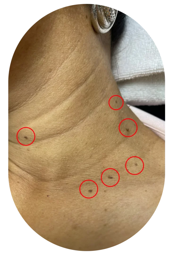 Co2 Laser Neck No14 Before P Act