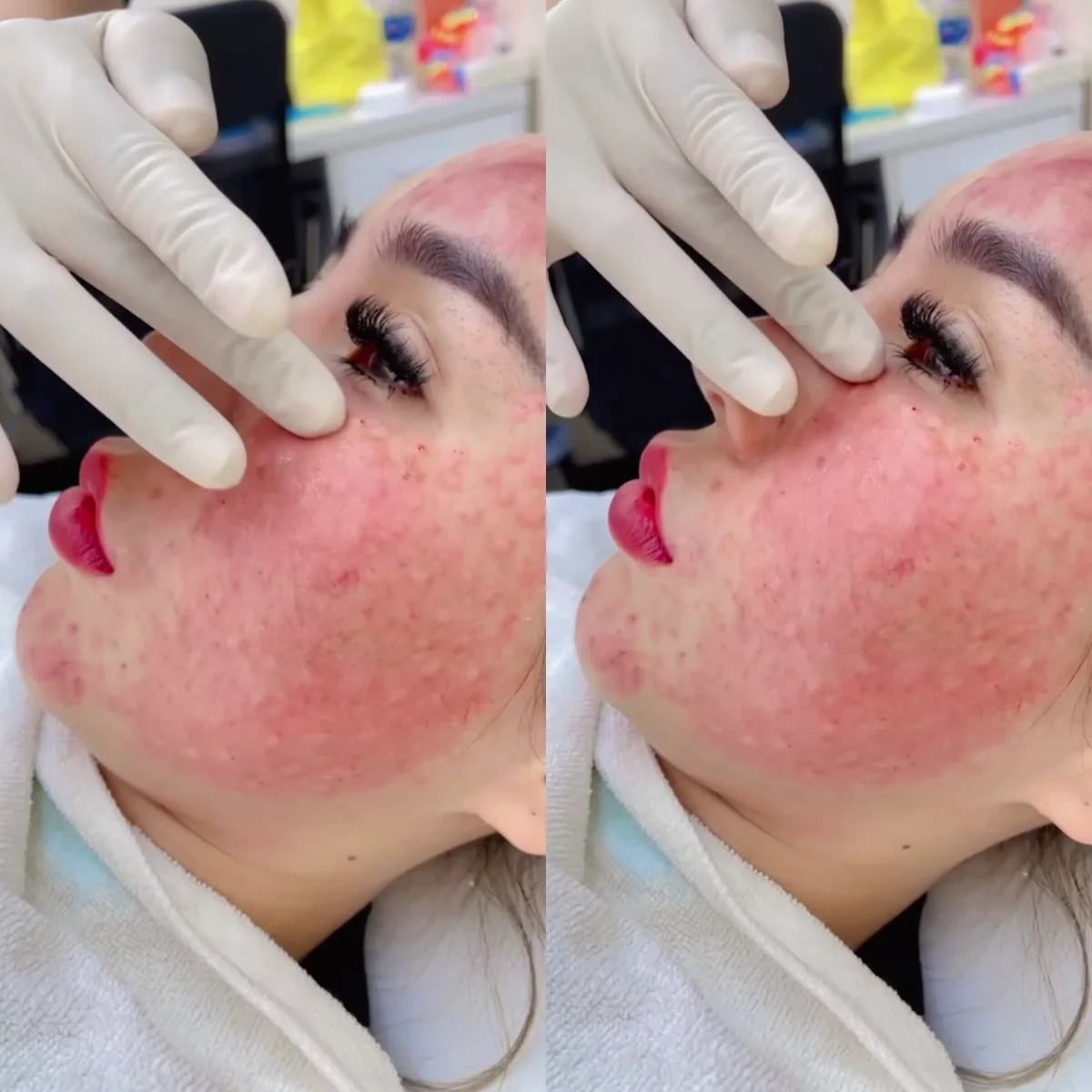 Close-up pore-tightening facial: gloved hand examines reddened cheek.
