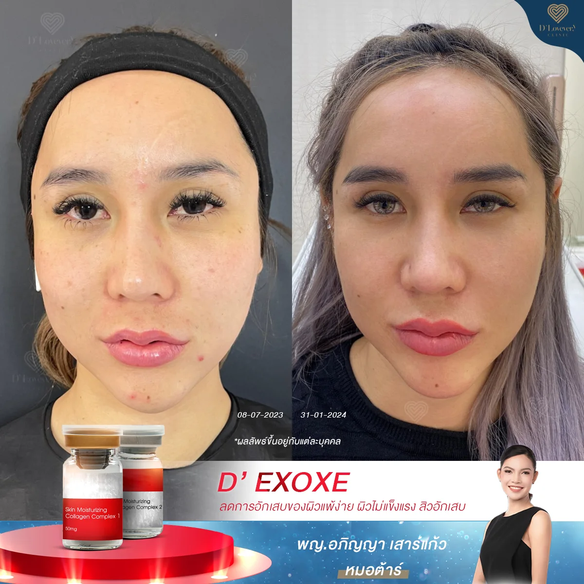 [รีวิว]EXOXE Exosome กล่องแดง ช่วยดูแลผิวแพ้ง่าย สิวอักเสบ เคสนี้ให้น้องกลับมามั่นใจอีกครั้ง