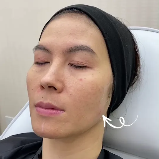 Subtle filler needle marks and mild redness on lower cheek and jaw in clinical close-up