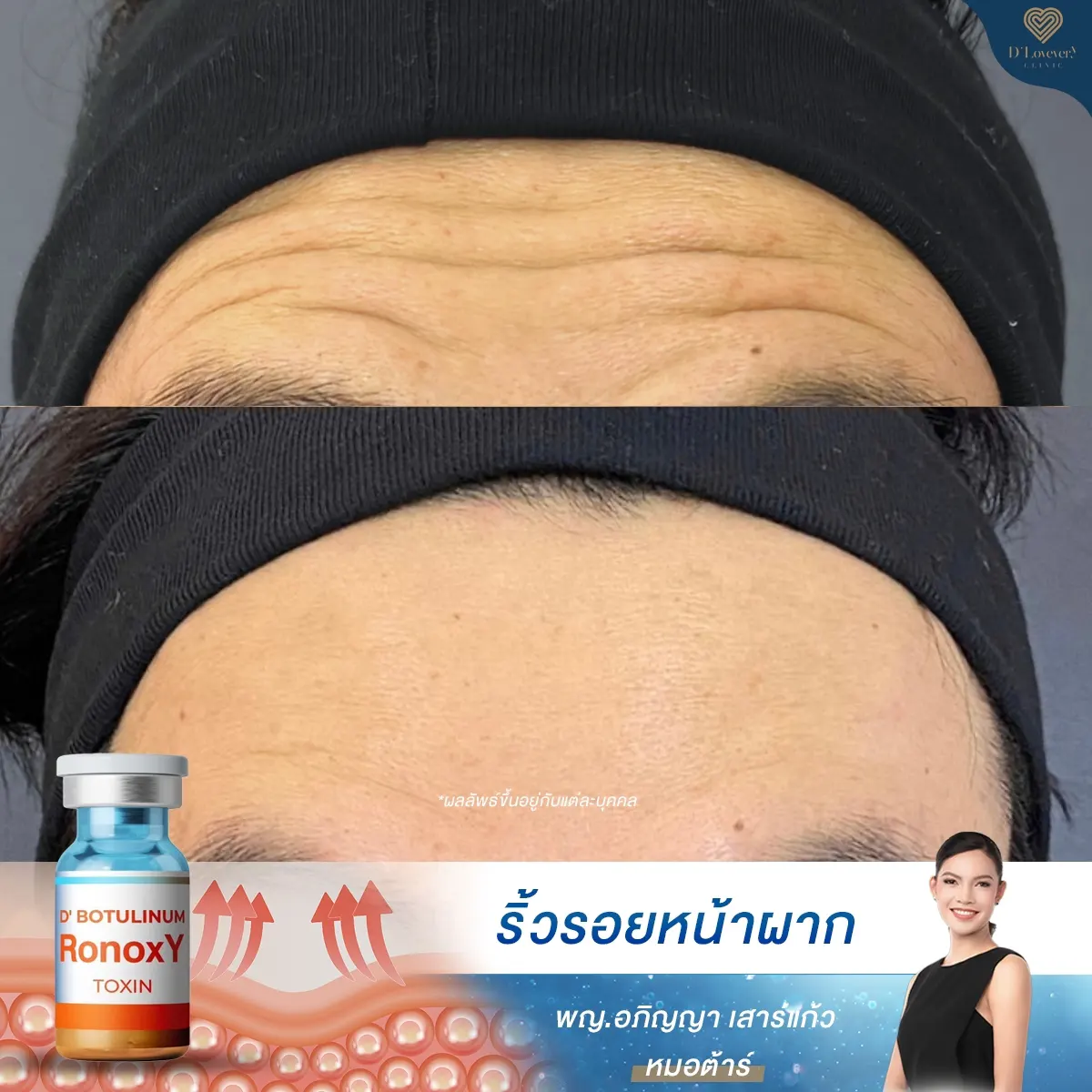 Forehead Botox before-and-after results: deep horizontal wrinkles smoothed, clinician graphic.