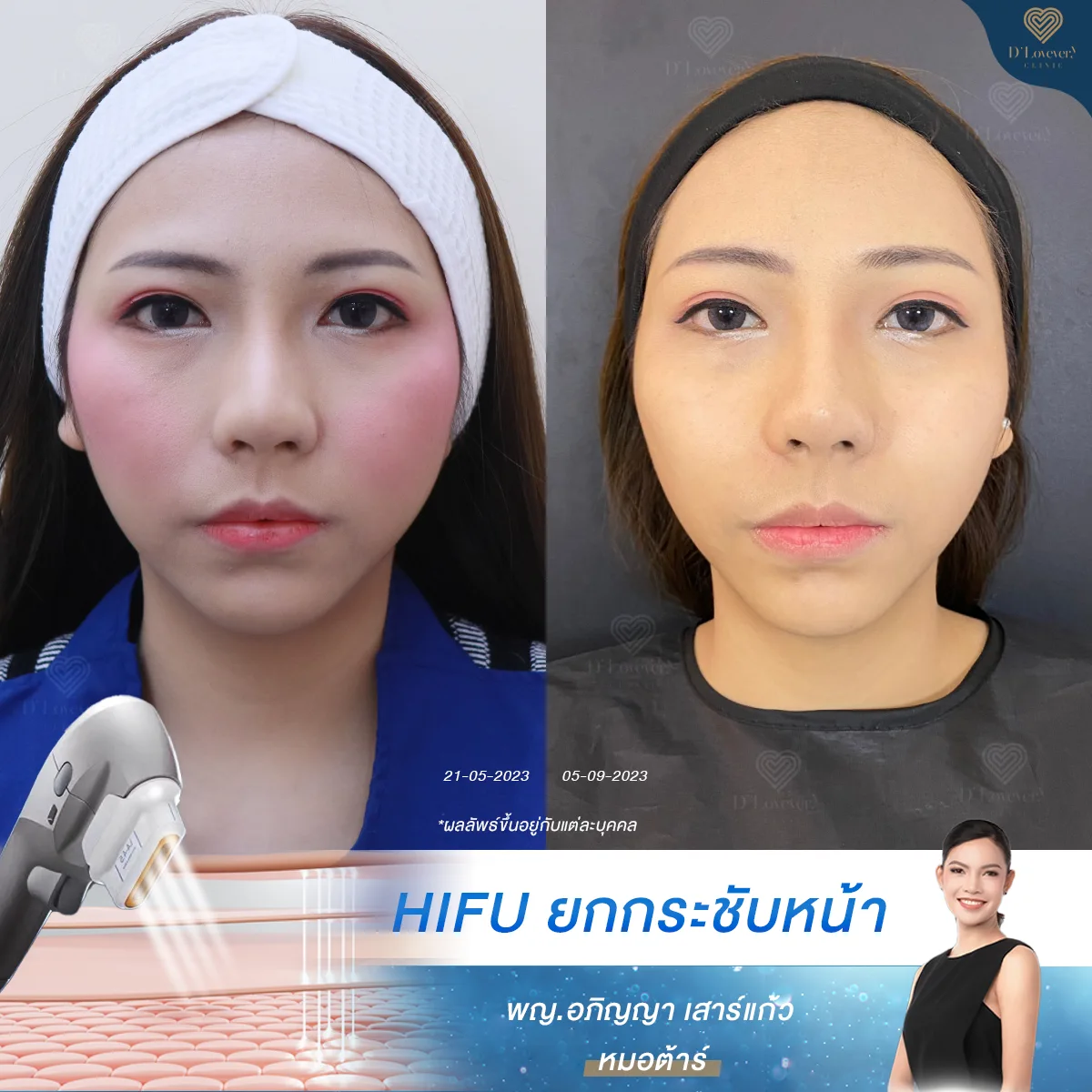Hifu Before After 1 5
