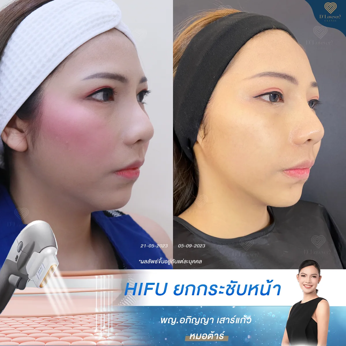 [รีวิว] HIFU เจอแล้ว! คลินิกที่จริงใจ ว่าหลังทำจะเห็นผลในกี่วัน ที่ดีเลิฟเวอรี่คลินิก เคลียร์ทุกอย่างที่เป็นตัวเลขให้คนไข้ได้หมด