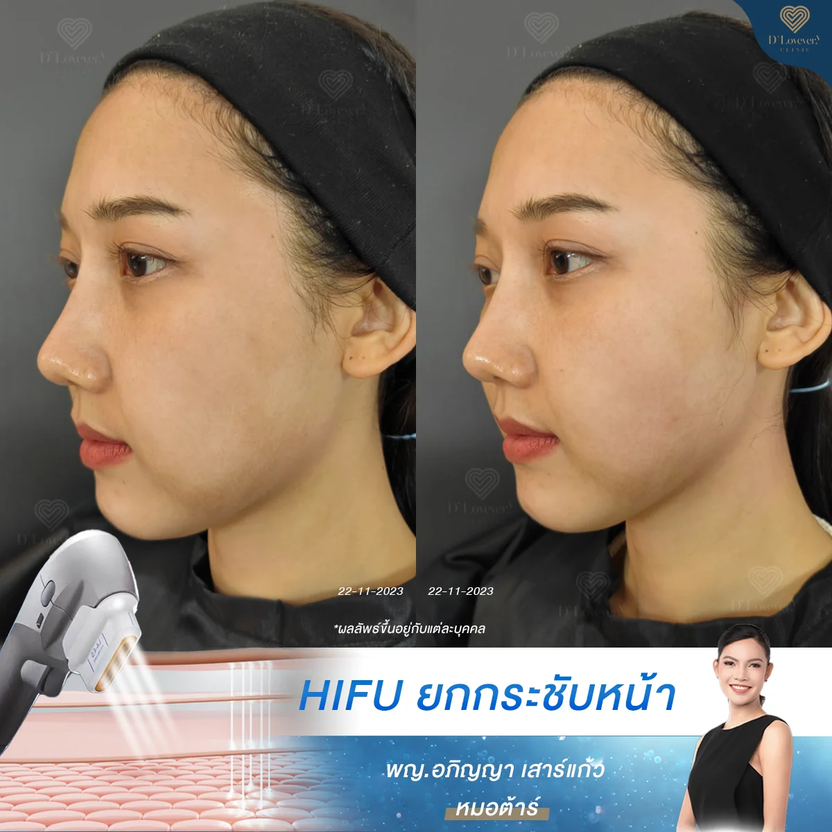 hifu รีวิว