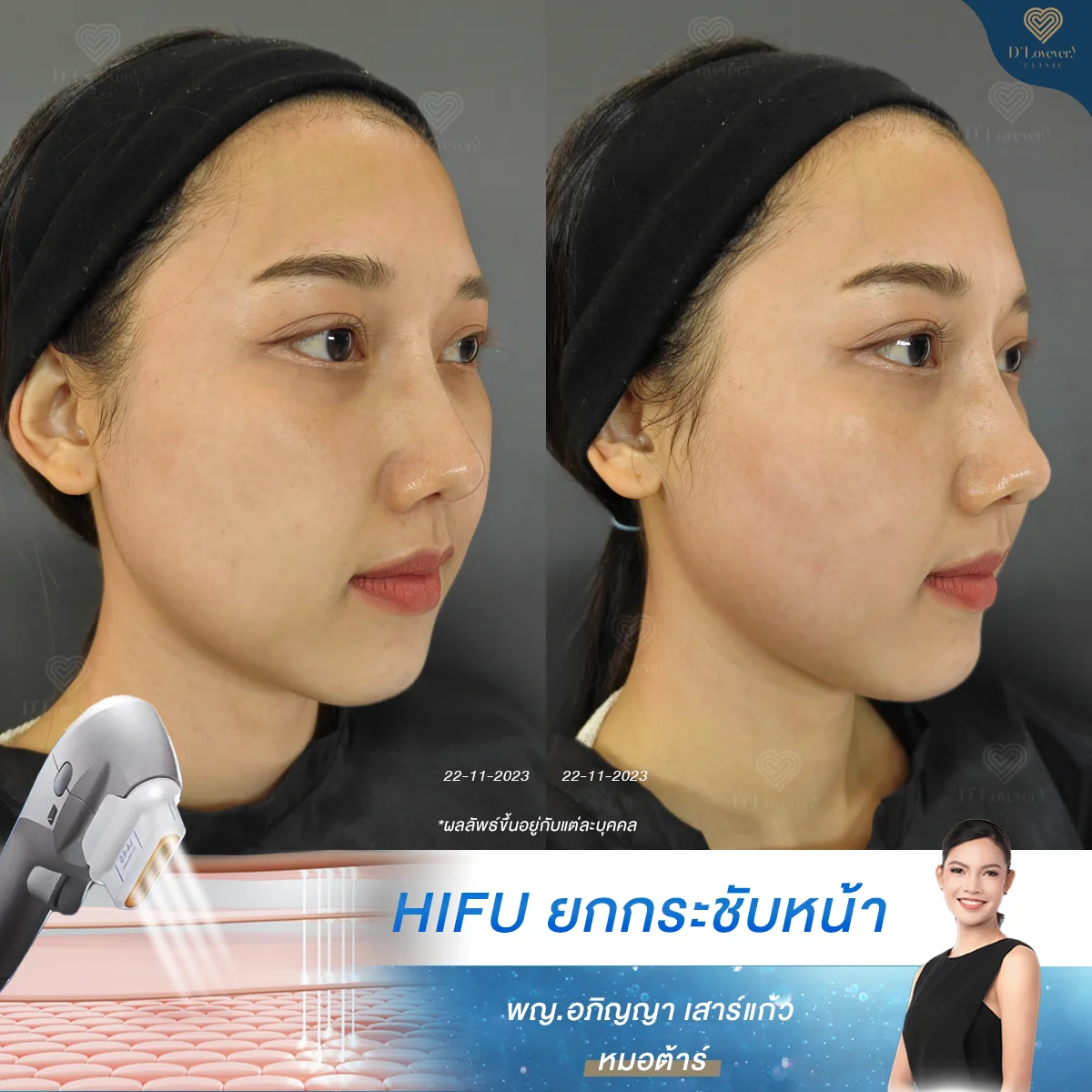 hifu รีวิว