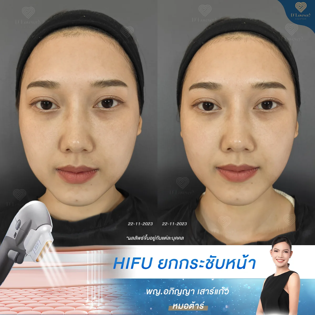 hifu รีวิว