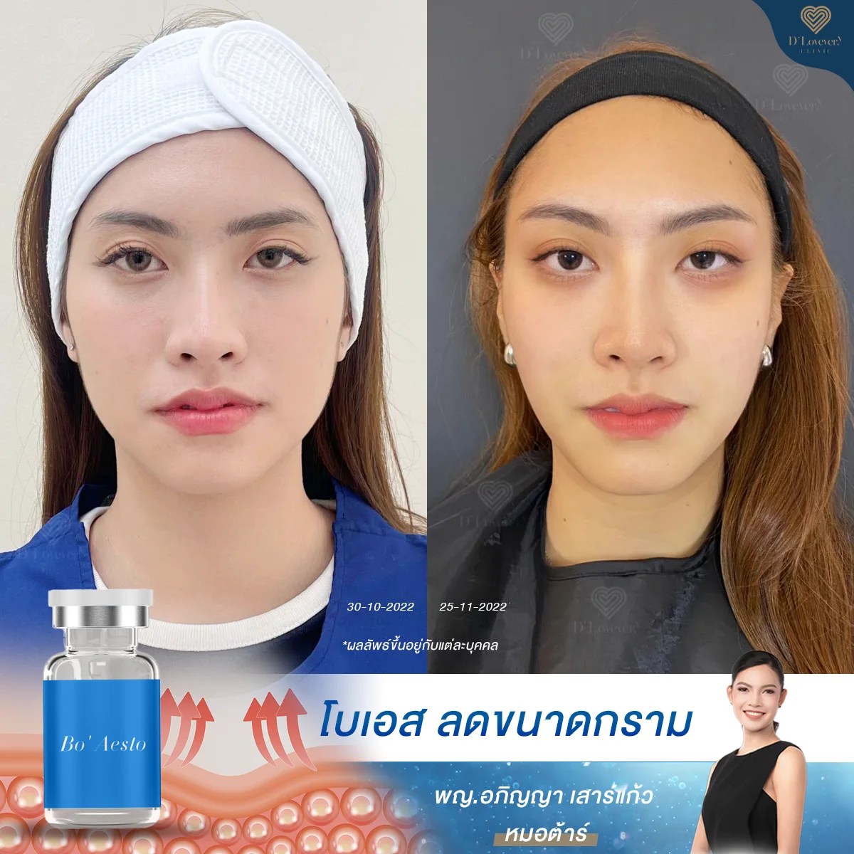 รีวิวฉีดโบ สำหรับคนอยากหน้าหวาน [อยากหน้าเล็ก] เห็นผลใน 7-14 วัน ไปดู Before After กัน