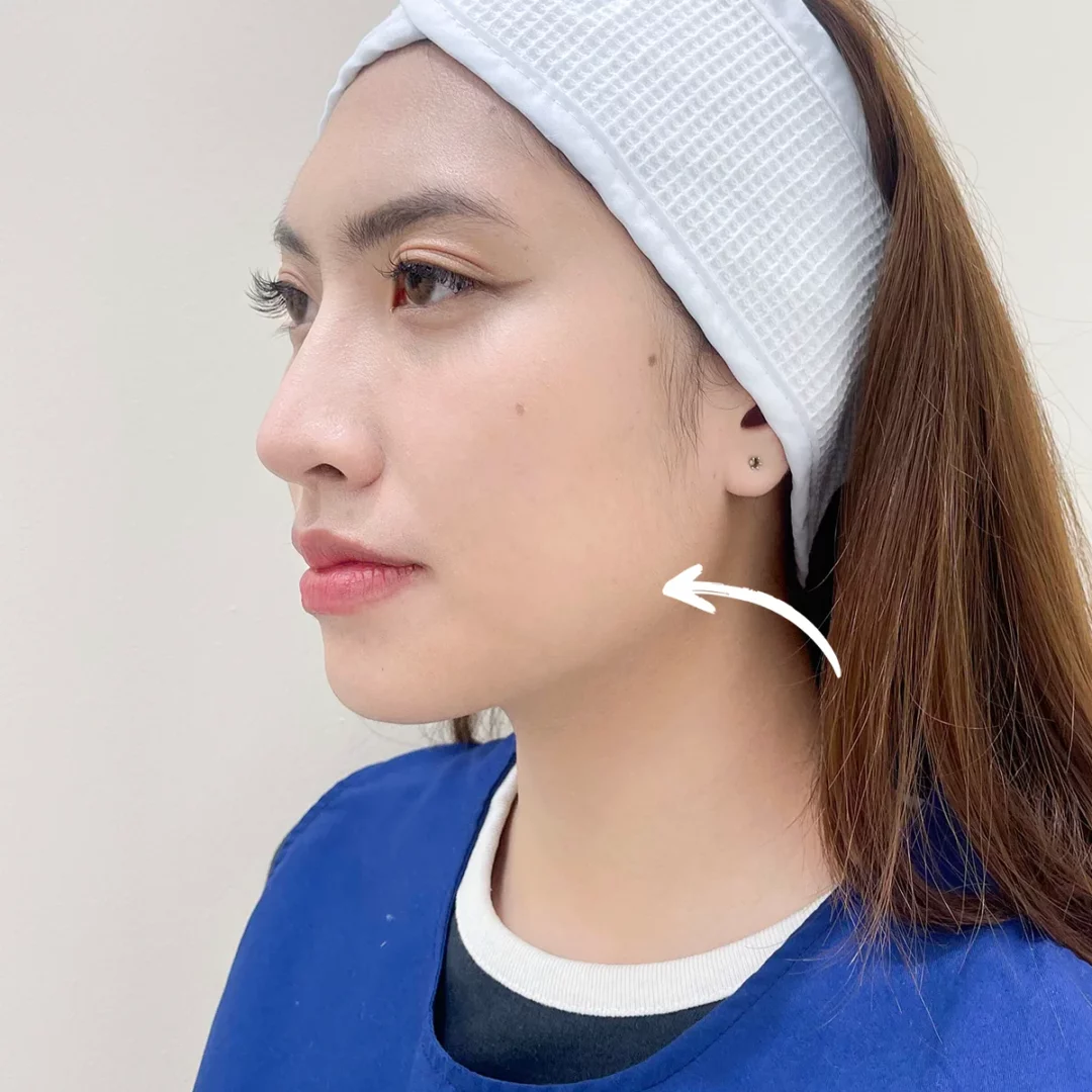 The atmosphere during jaw reduction injection for Nong View.