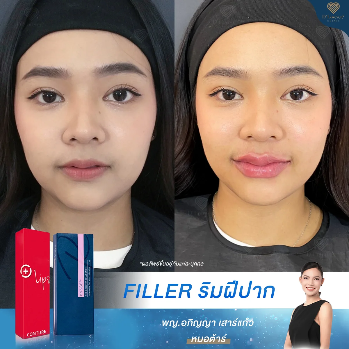 รีวิวฟิลเลอร์ปาก [ทรงเชอรี่] ปั้นทรงสวย กับแก้ปัญหาริมฝีปากบาง เล็ก ให้อวบอิ่ม ไปพร้อมกัน