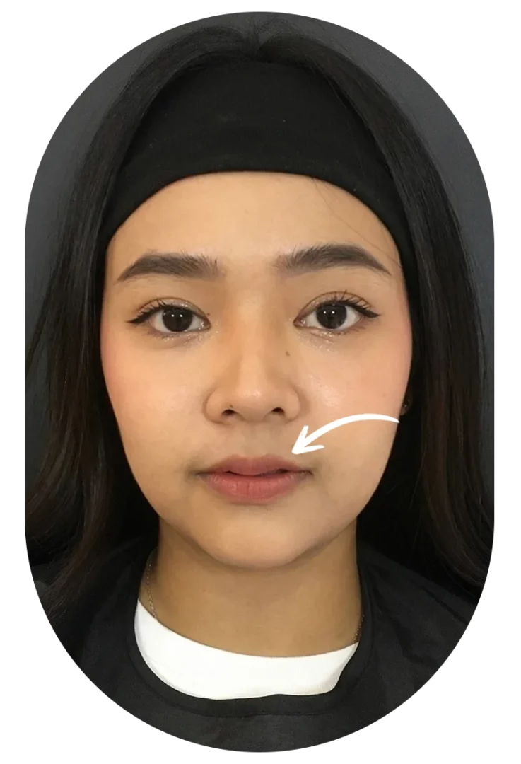 Before lip filler: close-up of young woman highlighting nasolabial fold