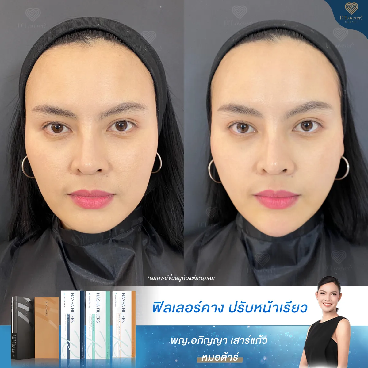 Miss Ploy Before After Chin Filler