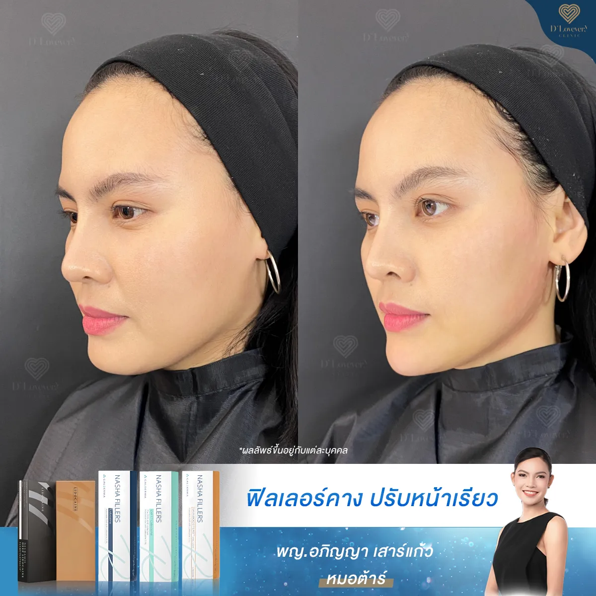 รีวิวฟิลเลอร์คาง