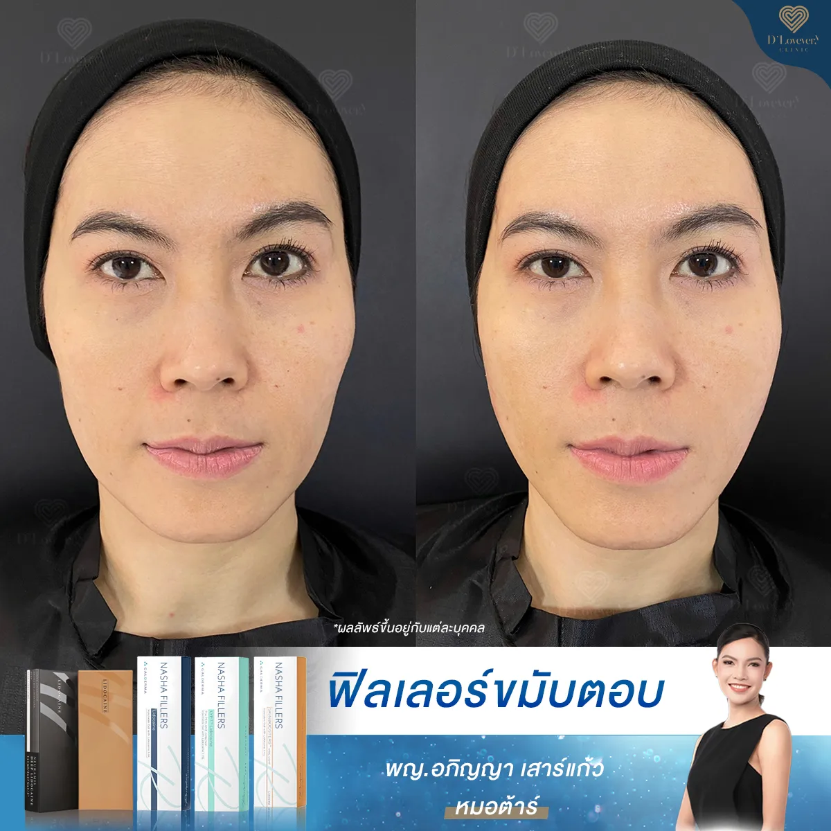 Miss Tunya Temple Cheek Filler Before After