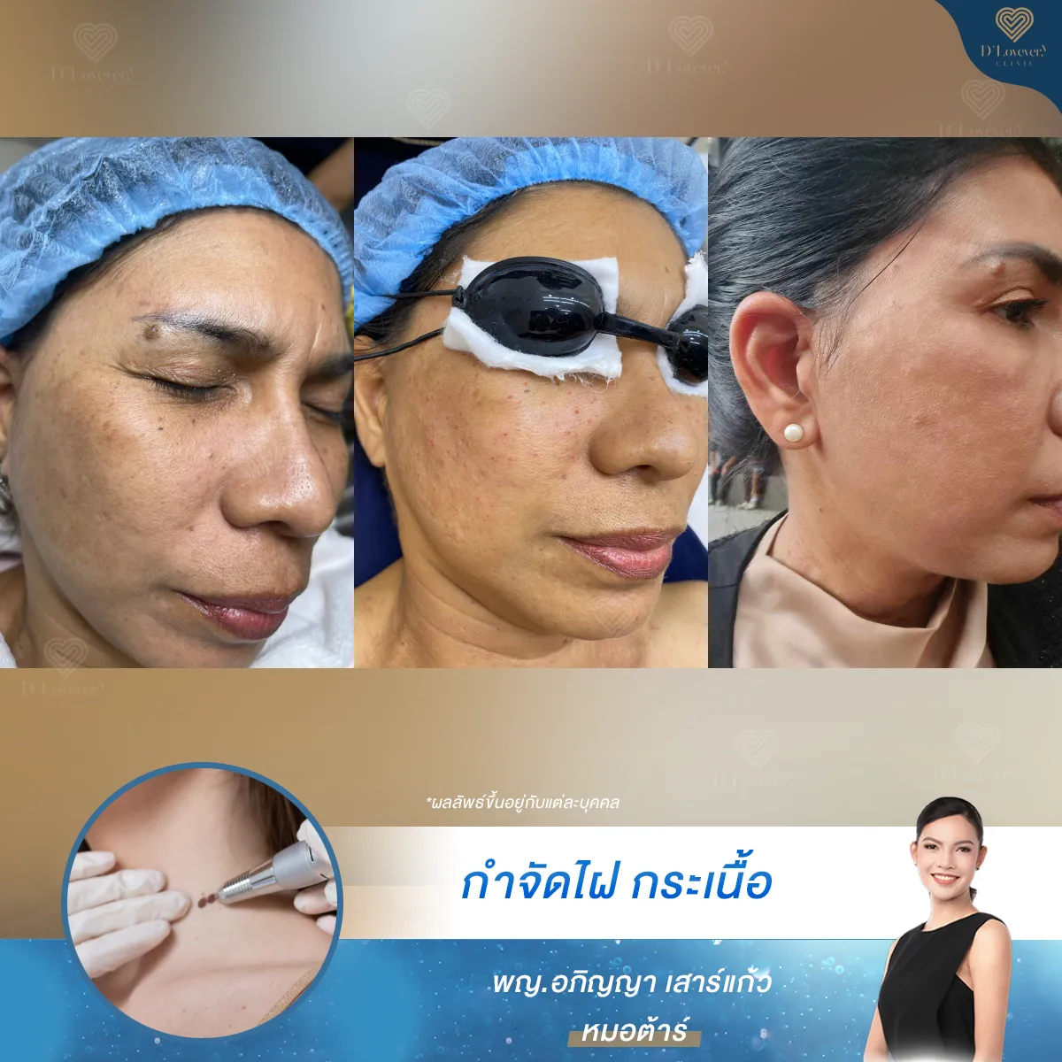 Facial mole and pigmentation removal before-and-after dermatology treatment close-ups