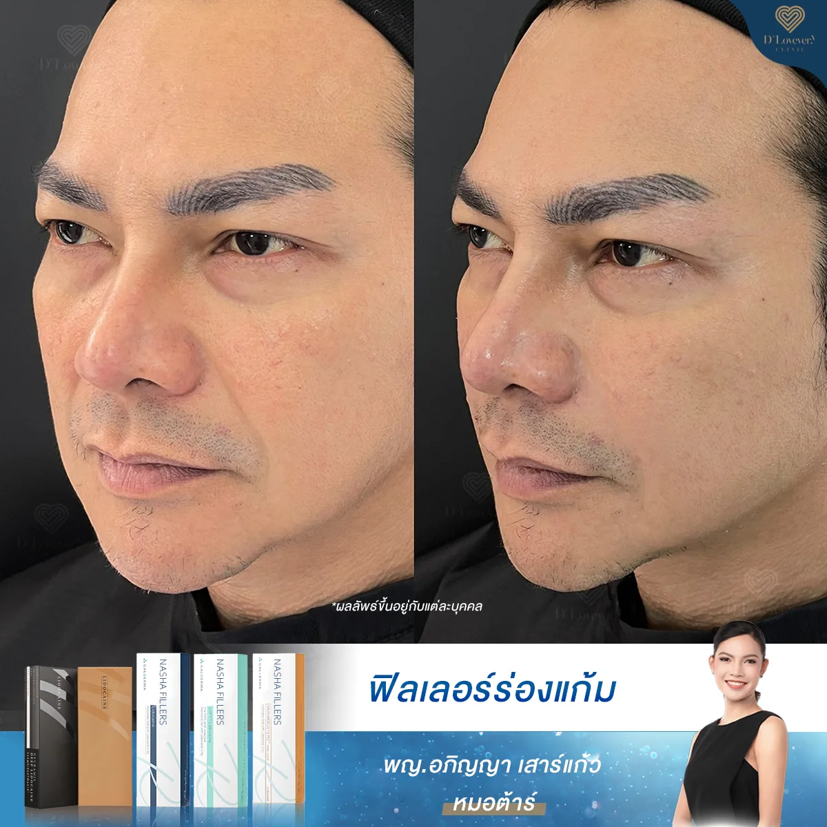 Mr Pawich Filler Nasolabial Before After